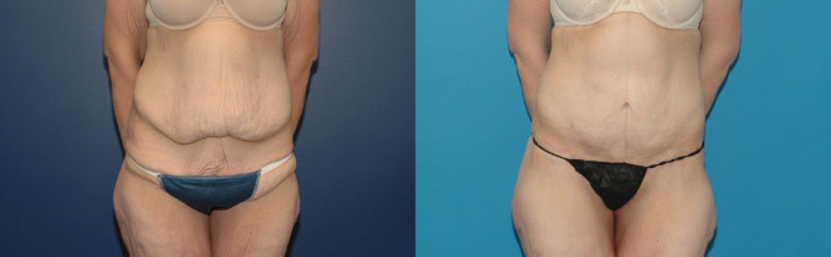 Tummy Tuck #13 - Before and After