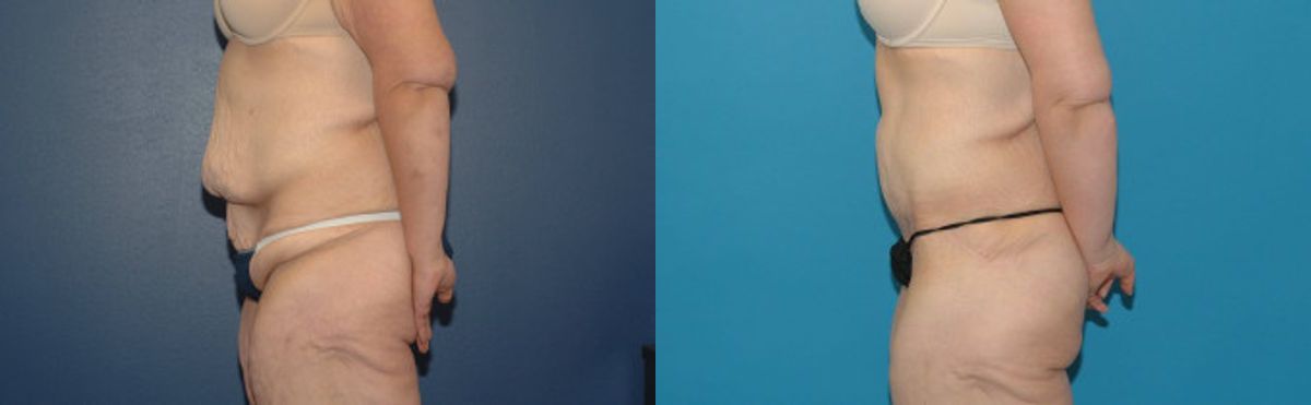 Tummy Tuck #13 - Before and After