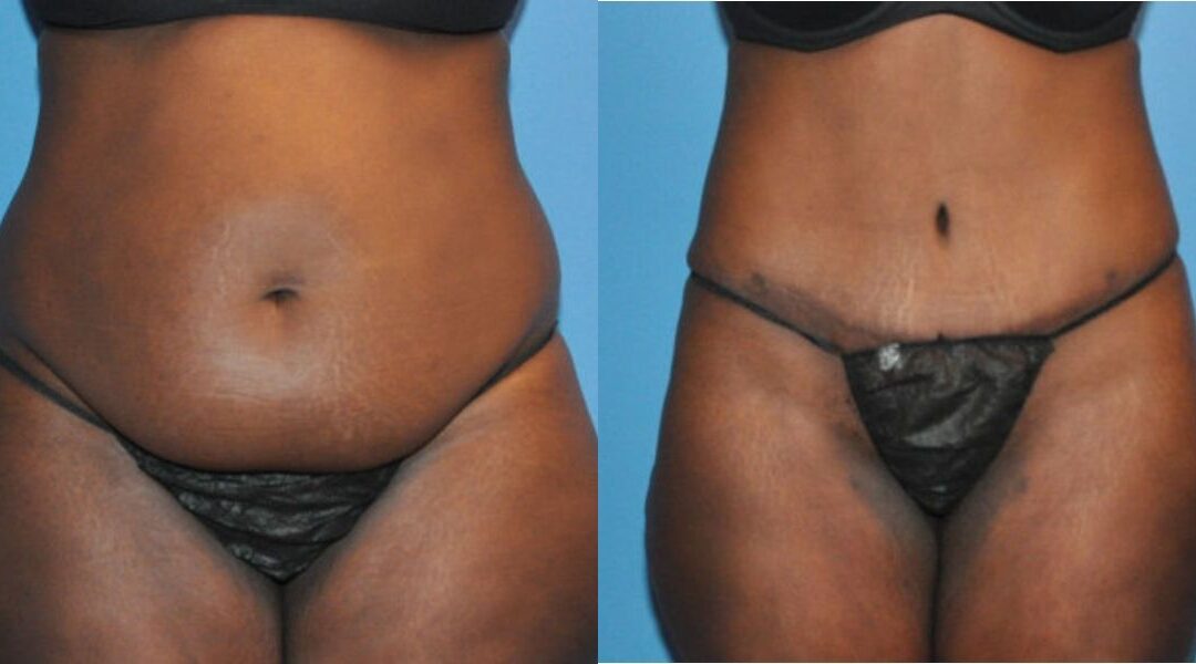 Tummy Tuck #14