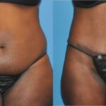 Tummy Tuck #14 - Before and After