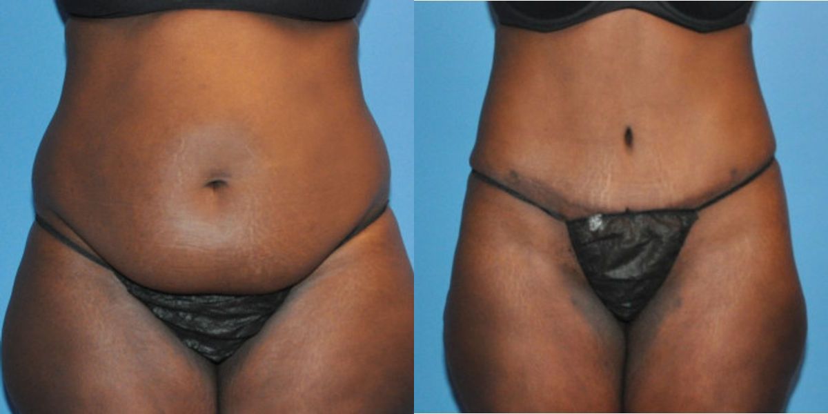 Tummy Tuck #14 - Before and After