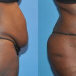Tummy Tuck #14 - Before and After