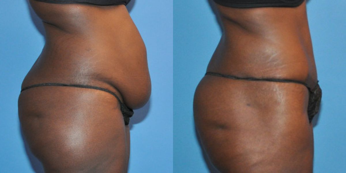 Tummy Tuck #14 - Before and After
