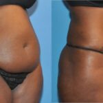 Tummy Tuck #14 - Before and After
