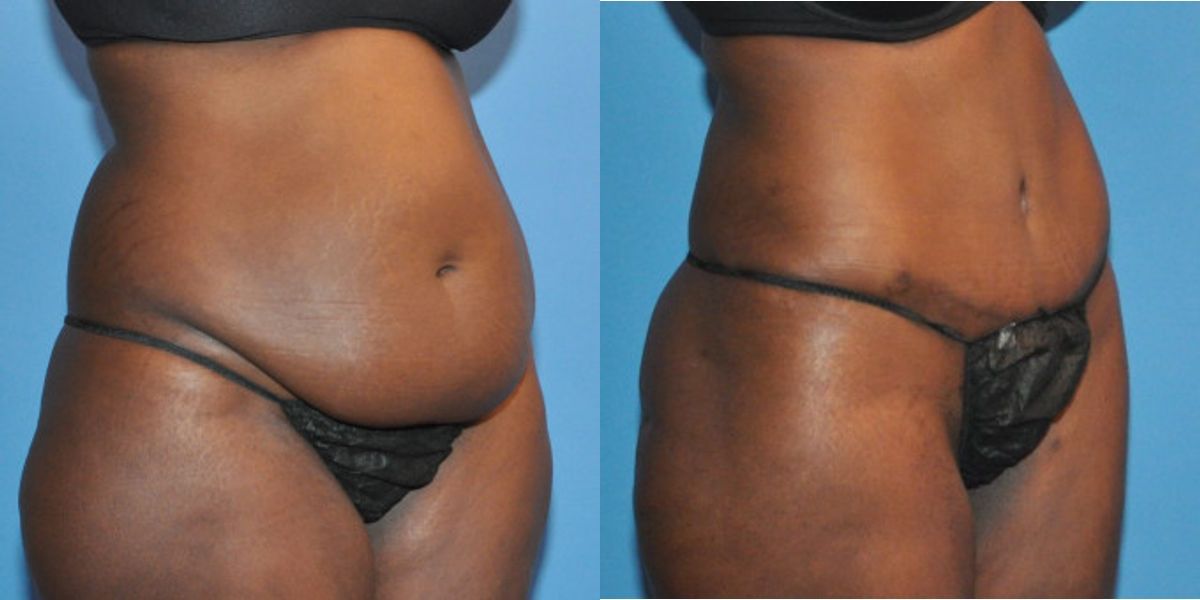 Tummy Tuck #14 - Before and After