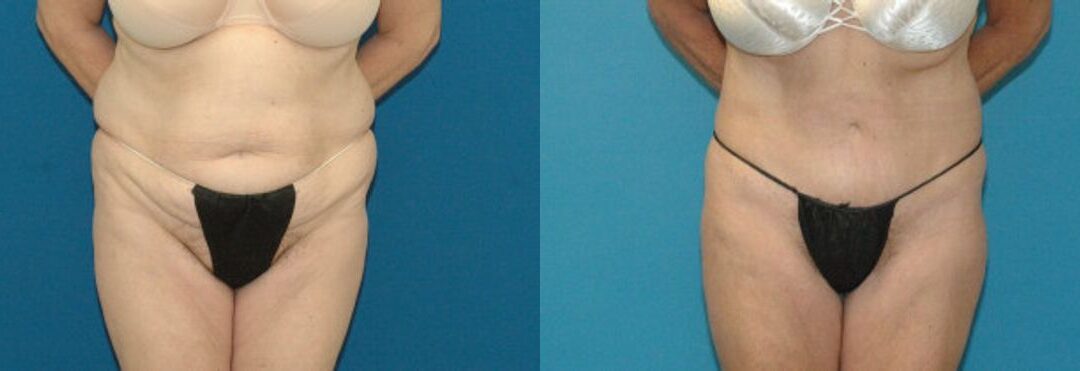 Tummy Tuck #15