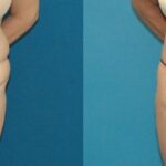 Tummy Tuck #15 - Before and After