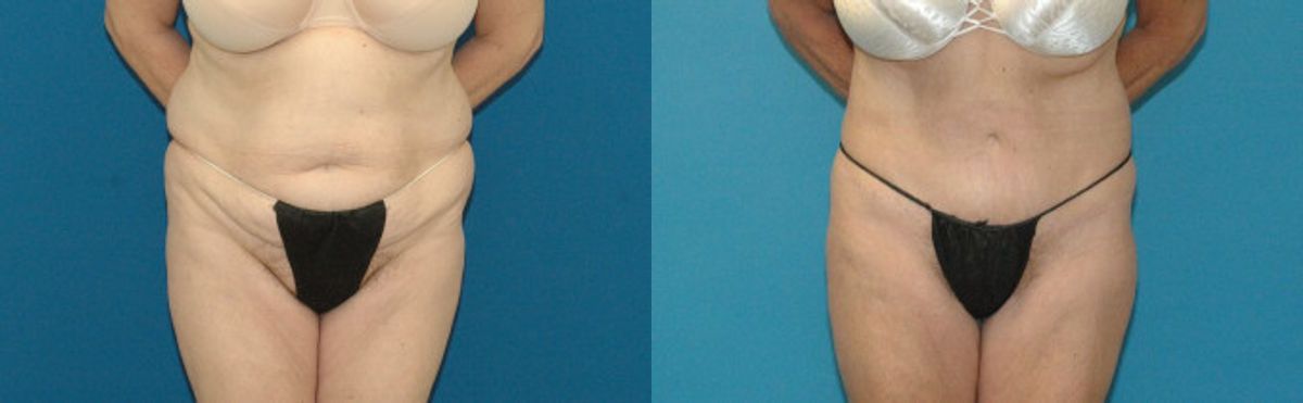 Tummy Tuck #15 - Before and After