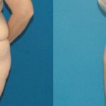 Tummy Tuck #15 - Before and After