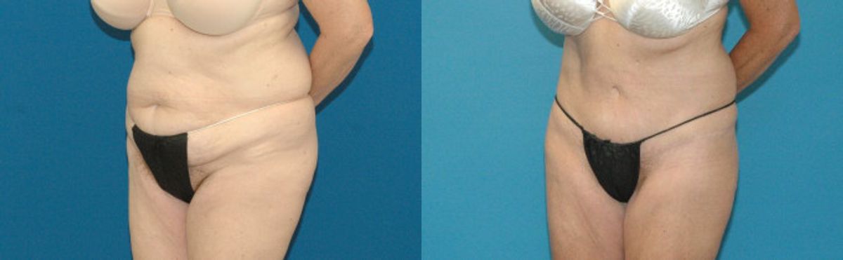 Tummy Tuck #15 - Before and After