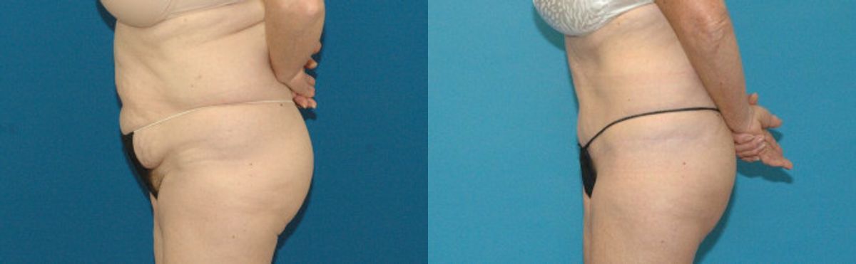 Tummy Tuck #15 - Before and After