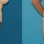 Tummy Tuck #15 - Before and After