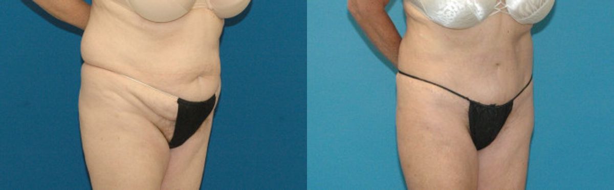 Tummy Tuck #15 - Before and After