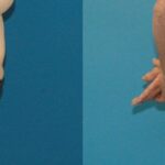 Tummy Tuck #15 - Before and After