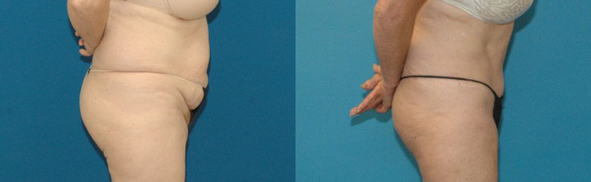 Tummy Tuck #15 - Before and After