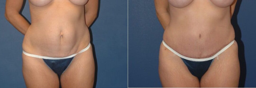 Tummy Tuck #16