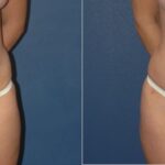 Tummy Tuck #16 - Before and After