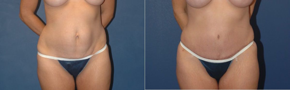 Tummy Tuck #16 - Before and After