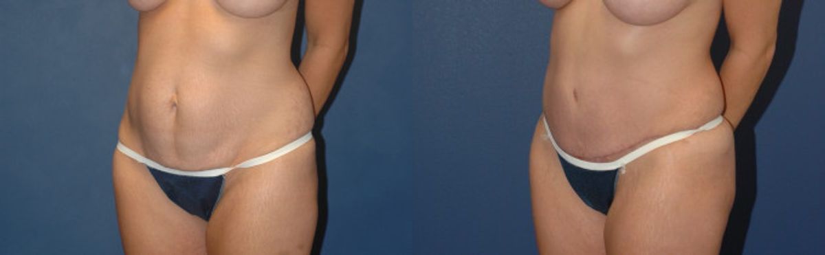 Tummy Tuck #16 - Before and After