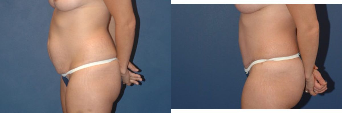 Tummy Tuck #16 - Before and After