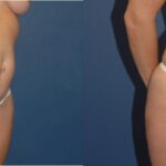 Tummy Tuck #16 - Before and After
