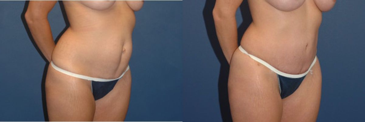 Tummy Tuck #16 - Before and After