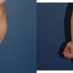 Tummy Tuck #16 - Before and After