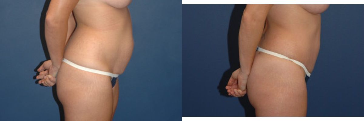 Tummy Tuck #16 - Before and After