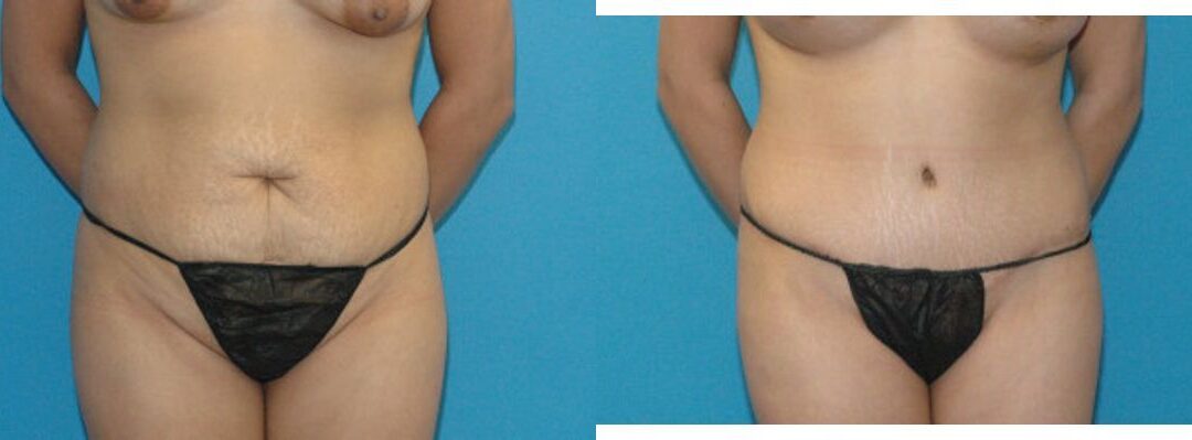 Tummy Tuck #17