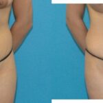 Tummy Tuck #17 - Before and After