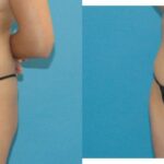 Tummy Tuck #17 - Before and After
