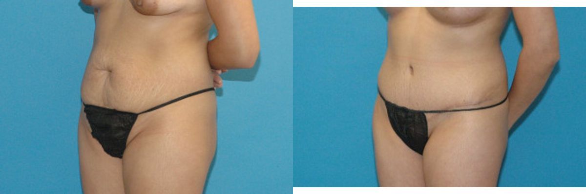 Tummy Tuck #17 - Before and After