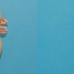 Tummy Tuck #17 - Before and After