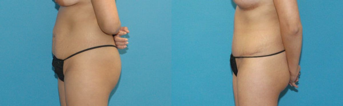 Tummy Tuck #17 - Before and After
