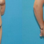Tummy Tuck #17 - Before and After