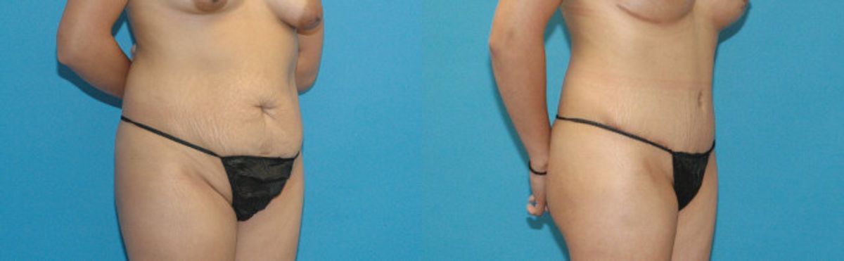 Tummy Tuck #17 - Before and After