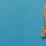 Tummy Tuck #17 - Before and After