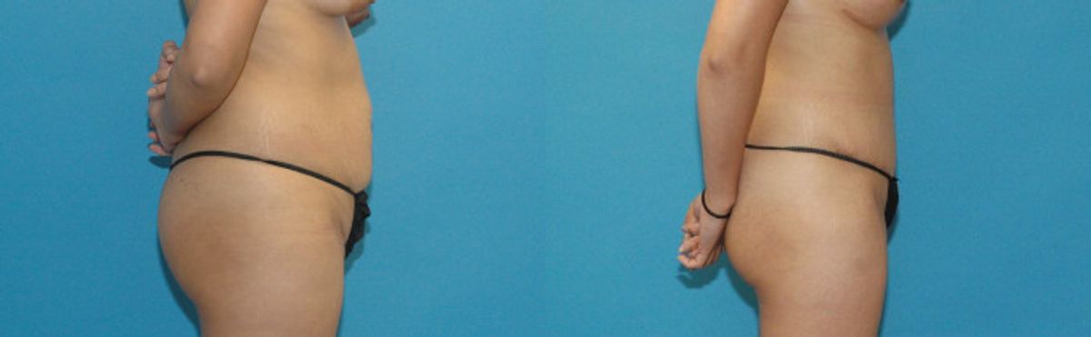 Tummy Tuck #17 - Before and After