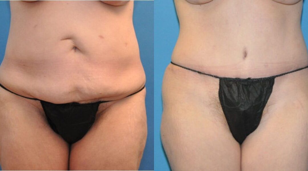 Tummy Tuck #18