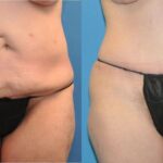 Tummy Tuck #18 - Before and After