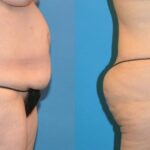 Tummy Tuck #18 - Before and After