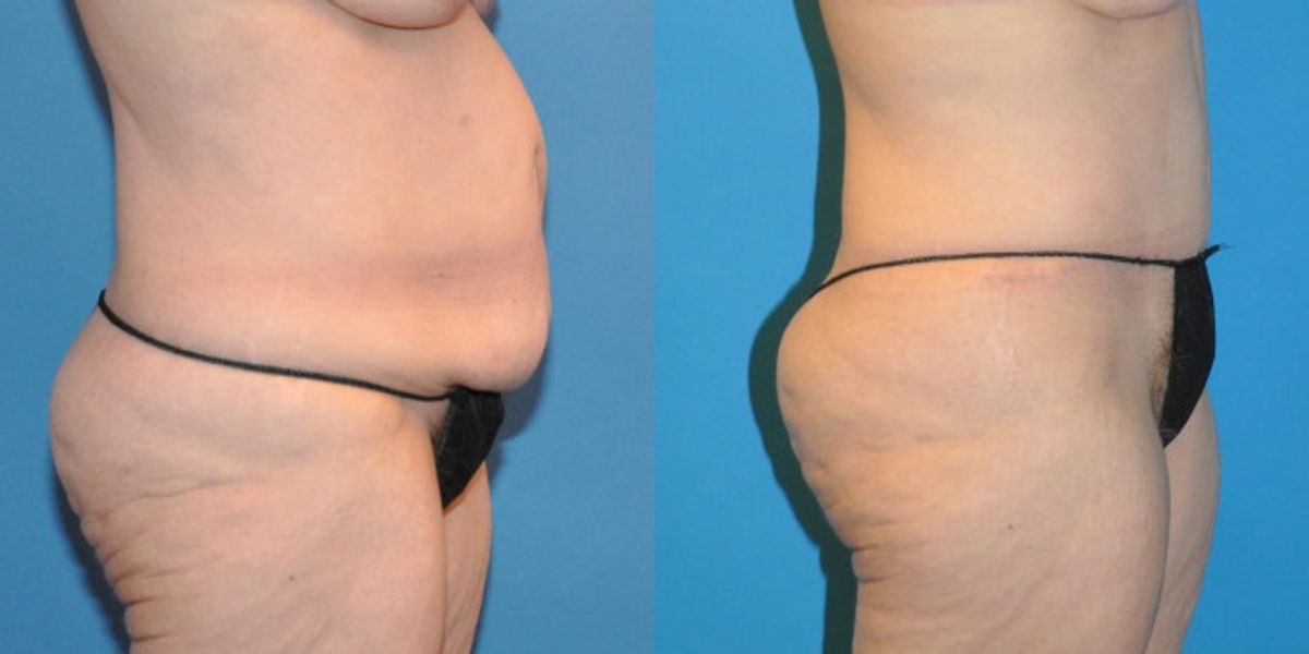 Tummy Tuck #18 - Before and After