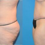 Tummy Tuck #18 - Before and After