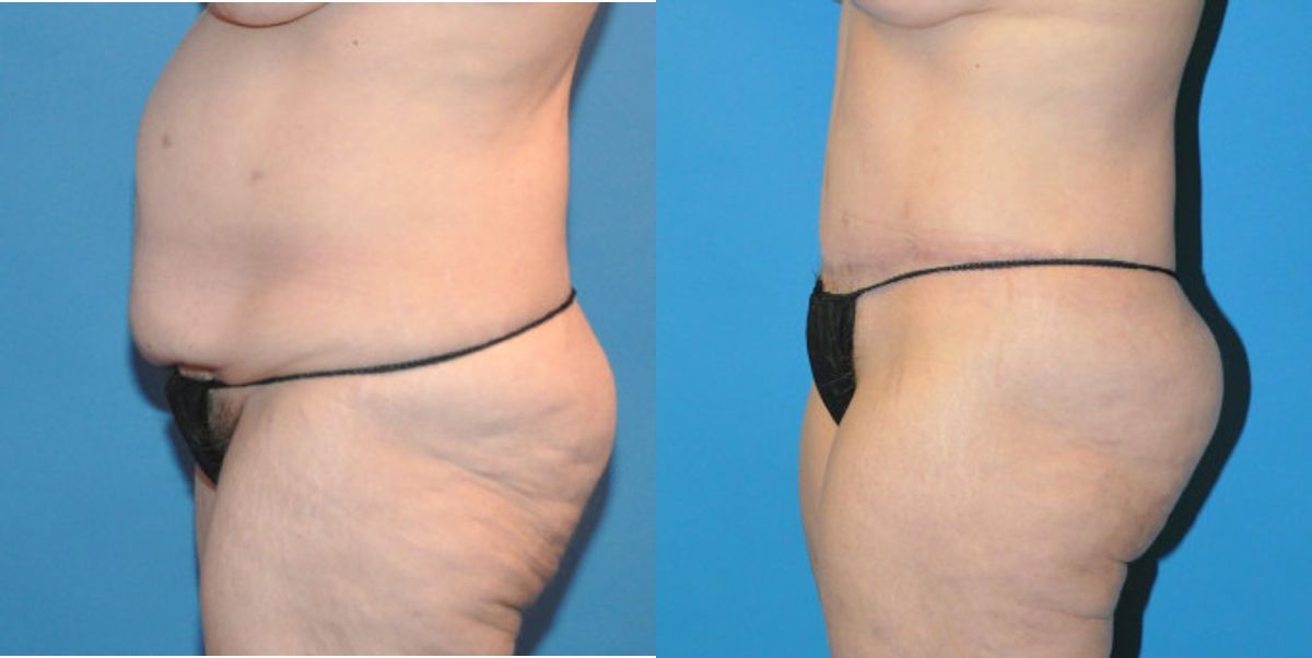 Tummy Tuck #18 - Before and After