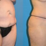 Tummy Tuck #18 - Before and After