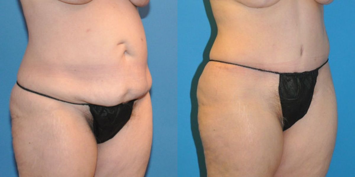Tummy Tuck #18 - Before and After