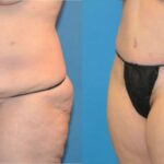 Tummy Tuck #18 - Before and After