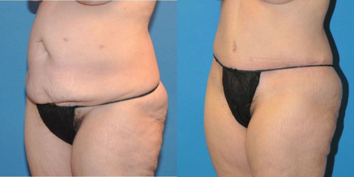 Tummy Tuck #18 - Before and After