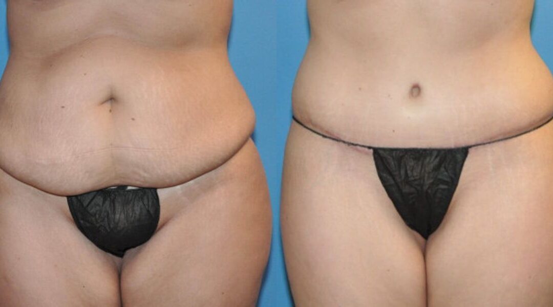 Tummy Tuck #19