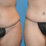 Tummy Tuck #19 - Before and After